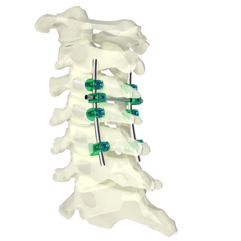 颈椎后路内固定系统