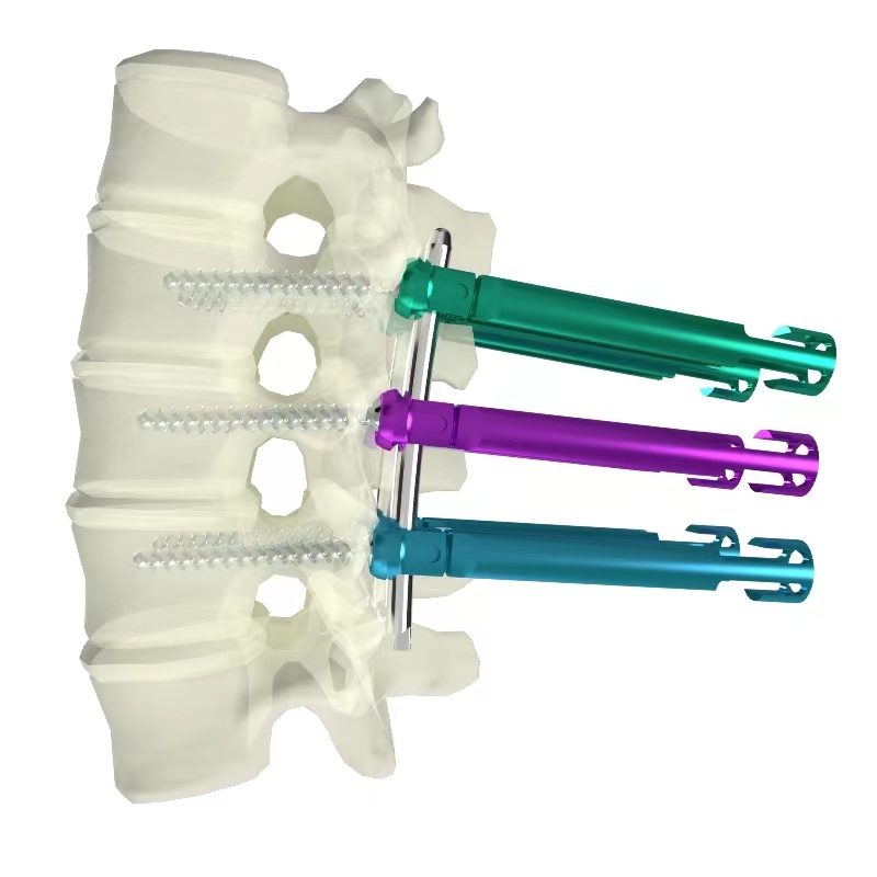 胸腰椎后路内固定系统